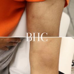 Basma Hameed Clinic - Arm scar
