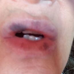 Bruises on my lips and upper lip... crazy Bruises on my lips and upper lip... crazy