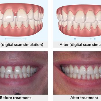 Hillview Dental Care - Looking for a change? Invisalign might be the way to go! - General Dentistry Near Me - Ventura, California Hillview Dental Care - Looking for a change? Invisalign might be the way to go! - General Dentistry Near Me - Ventura, California