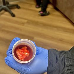 HealthySkin Medical & Cosmetic Dermatology - THAT, was growing on the back of my neck( lipoma)