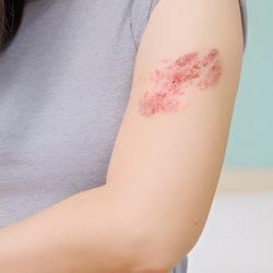 ACS Dermatology - Rash & Eczema Treatment