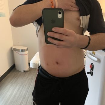 Flip Your Look - Second treatment on my stomach using the XL applicator for the first time (look at the red outline to see how much it treats). - Medical Spas Near Me - Irvine, California