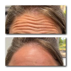 Artem Med Spa - Smooth, youthful foreheads await! Erase those lines with our expert Botox treatments. Look refreshed and rejuvenated now! #ForeheadBotox
