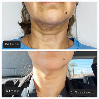 KG Recovery Lounge - The Magic of RF Microneedling. Actual Client! - Saunas Near Me - Las Vegas, Nevada KG Recovery Lounge - The Magic of RF Microneedling. Actual Client! - Saunas Near Me - Las Vegas, Nevada