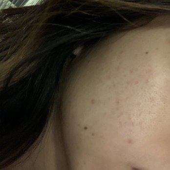 Pure Skin Lounge - Before - Skin Care Near Me - San Diego, California Pure Skin Lounge - Before - Skin Care Near Me - San Diego, California