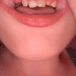 Gaston Dental Associates - My gum was still irritated and my appointment for fillings was in june.