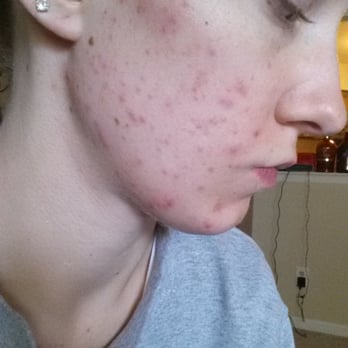 Brow Art 23 - Bad case of folliculitus that occurred immediately after threading. And this is five days later - Beauty & Spas Near Me - Novi, Michigan Brow Art 23 - Bad case of folliculitus that occurred immediately after threading. And this is five days later - Beauty & Spas Near Me - Novi, Michigan