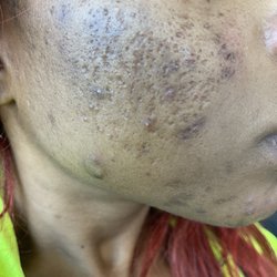 Dimitri Dermatology - My ance scars are deep due to the fractora laser my dermatologist wanted me to pay 89$ for a Retin A gel