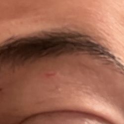 Eyebrow Republic - Here you can see where I was cut under brow pretty badly.  This is 2 days old.