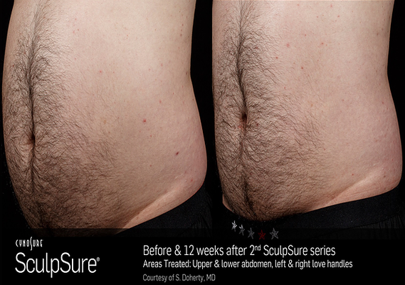 Lbc Laser Md 35 Photos Laser Hair Removal 3760 Atlantic Ave