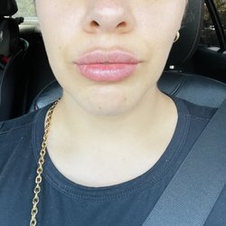 Beverly Hills Rejuvenation Center - Westlake Village - After fillers