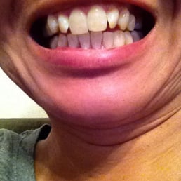 Few hours after Zoom teeth whitening! Thank you Dr. Wong and Yana!
