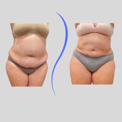 Blue Wolf Transformations - Lipo 360