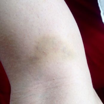 知足樂 - Bruising from the massage that was more of a cruel beating from an older woman storing major hurt issues that were taken out on me. - Massage Near Me - Hong Kong, HK 知足樂 - Bruising from the massage that was more of a cruel beating from an older woman storing major hurt issues that were taken out on me. - Massage Near Me - Hong Kong, HK