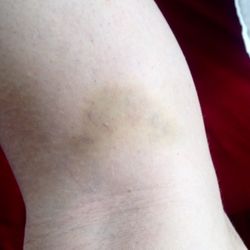 知足樂 - Bruising from the massage that was more of a cruel beating from an older woman storing major hurt issues that were taken out on me.
