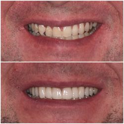 Limitless Dental Jersey City - Clear aligners and 10 veneers