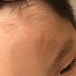 hurt by the rope of the climbing structure hurt by the rope of the climbing structure