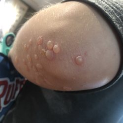 Pinnacle Dermatology - Oak Lawn - Acne. Dry skin. Neither jackass