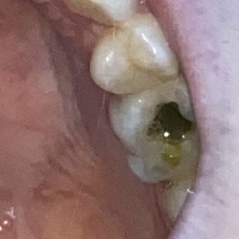 Lake County Dental - Gaping hole with food inside :) - Cosmetic Dentists Near Me - Mentor, Ohio Lake County Dental - Gaping hole with food inside :) - Cosmetic Dentists Near Me - Mentor, Ohio