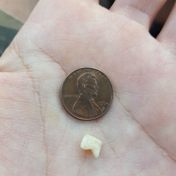 New Spice World - Broken tooth from glass in food - Indian Near Me - Corona, California