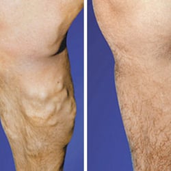 Shah Mehul N MD - VARICOSE VEINS