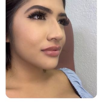 Prairie Medical Spa - Lip fillers after photo. - Medical Spas Near Me - Beverly Hills, California Prairie Medical Spa - Lip fillers after photo. - Medical Spas Near Me - Beverly Hills, California