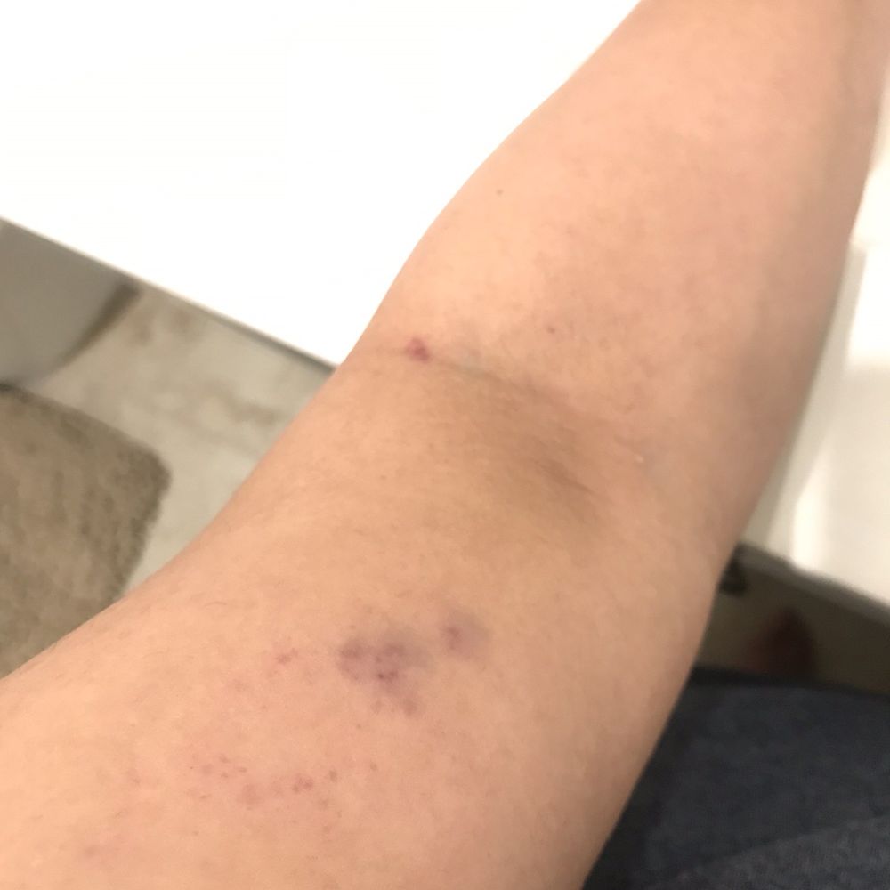 New Life Spa - Left hand bruising. - Skin Care Near Me - Newark, California