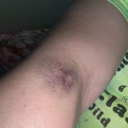 Life Is Beautiful, MD - Update: the inexperienced student who attempted to draw my blood, but failed both times, left a nasty bruise on my arm