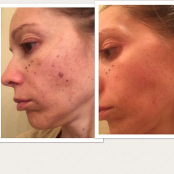 NEOS Med Spa - Laser Hair Removal Near Me - Tempe, Arizona NEOS Med Spa - Laser Hair Removal Near Me - Tempe, Arizona