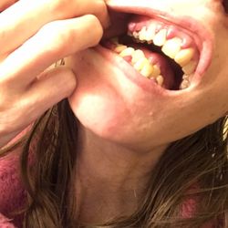 Wilson Dental - My gums are so swollen I have a lisp and can barely chew. It was at the beginning stages when he wasted my time.