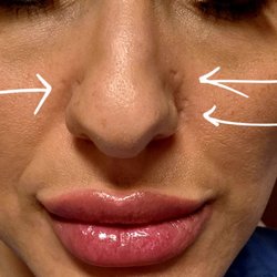 Syracuse Plastic Surgery Skin & Wellness - Burned holes in my face that will never heal. Does anyone know any good lawyers? .. This place ruined my life