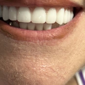 Eastgate Dental - Funky dentures...notice how they don't line up with the lips. - General Dentistry Near Me - Bellevue, Washington