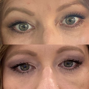 TotalCare Wellness Center - Eyes are dropped and forehead heavy in the bottom after pic. (Top is before) - Medical Spas Near Me - Chino, California