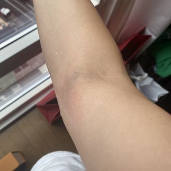 Quest Diagnostics - My blown vain looked this way , the photo taken 20 min afte the test - Laboratory Testing Near Me - New York, New York Quest Diagnostics - My blown vain looked this way , the photo taken 20 min afte the test - Laboratory Testing Near Me - New York, New York