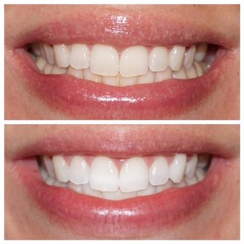 Pure Brilliance Teeth Whitening - Teeth Whitening Near Me - Johnston, Rhode Island
