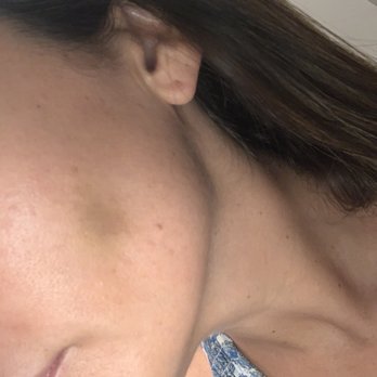Redefine Aesthetics - A week later and my primary care Dr said is actually a hematoma from the Dr doing the injection incorrectly. - Medical Spas Near Me - Kissimmee, Florida Redefine Aesthetics - A week later and my primary care Dr said is actually a hematoma from the Dr doing the injection incorrectly. - Medical Spas Near Me - Kissimmee, Florida