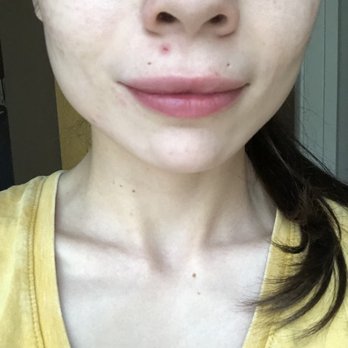 Juvena Skin Care - This is my skin now! I want to point out that the blemish under my nose is irritation from a bad cold. - Skin Care Near Me - Las Vegas, Nevada Juvena Skin Care - This is my skin now! I want to point out that the blemish under my nose is irritation from a bad cold. - Skin Care Near Me - Las Vegas, Nevada
