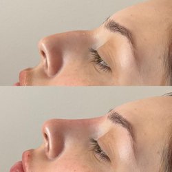 Cynthetic Medi - liquid nose job in 10 minutes!