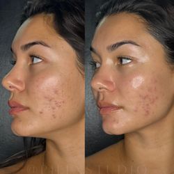 Piel Studio - Face Reality Acne Peel