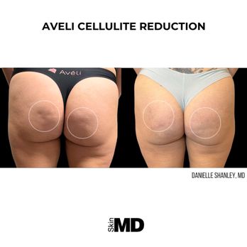 SkinMD - Treating Cellulite with Aveli - this procedure is a game changer! - Skin Care Near Me - Hyannis, Massachusetts SkinMD - Treating Cellulite with Aveli - this procedure is a game changer! - Skin Care Near Me - Hyannis, Massachusetts