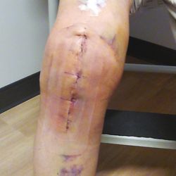 Boyden Eric M MD - Won't lie, this hurts like hell, not for sissies!