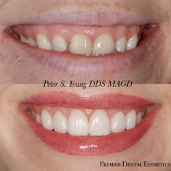 Premier Dental Esthetics | Dentist Arcadia - Extremely happy patient that had laser gum lift and 8 veneers.  Very nice transformation.