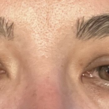 Bair Medical Spa - Swelling in eyes every morning after a yr. They said they take responsibility but did nothing to fix damage - Medical Spas Near Me - Albuquerque, New Mexico Bair Medical Spa - Swelling in eyes every morning after a yr. They said they take responsibility but did nothing to fix damage - Medical Spas Near Me - Albuquerque, New Mexico