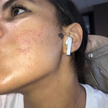 dr LASER - 1day post facial - Skin Care Near Me - Santa Monica, California dr LASER - 1day post facial - Skin Care Near Me - Santa Monica, California