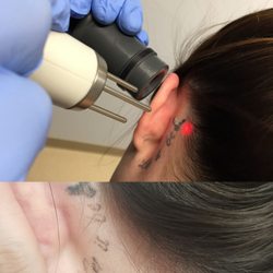 New beginnings Laser Tattoo Removal - This picture is a treatment started the bottom picture is after 2 treatments with a few more treatments to go.