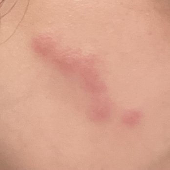 Woodbridge Gardens Apartments - Bug bites - Apartments Near Me - Lake, California