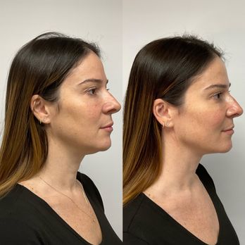 glutathione bellevue RENEW BEAUTY - Updated August 2026 - 16301 NE 8th St, Bellevue, Washington - Medical Spas - Phone Number bpc-157 nasal spray dosage seal-no-preservatives Variant:20mg