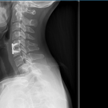 Dallas Neurosurgical and Spine - Xray  peek bone graft, titanium plate and screws. On my MRI Chiari Malformation was even mentioned, he didn't care, left me to the wolves. - Neurologist Near Me - Plano, Texas