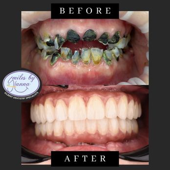 Smiles By Hanna - Dental Implants - Cosmetic Dentists Near Me - Gilbert, Arizona Smiles By Hanna - Dental Implants - Cosmetic Dentists Near Me - Gilbert, Arizona