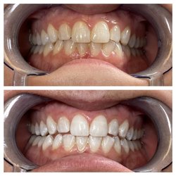Posh Amore Beauty Bar - Teeth Whitening